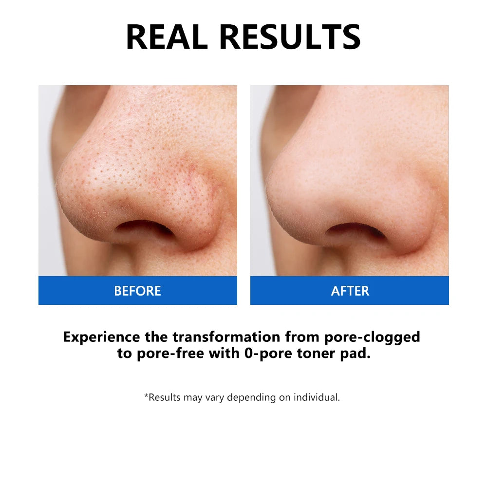 Zero Pore Toner Pads Control Oil Reduce Sebum Exfoliate Deep Clean Refines Pores Antioxidant Skincare Treatment Skincare Korean